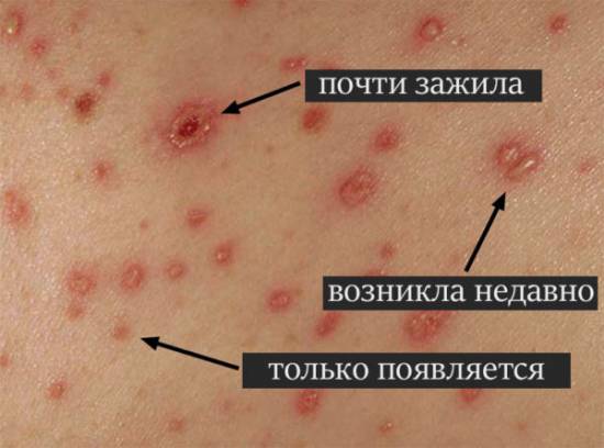 сыпь