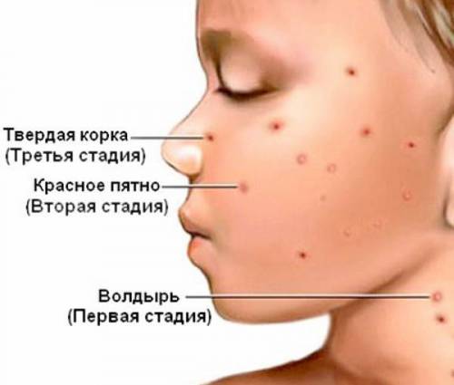 Стадии ветрянки