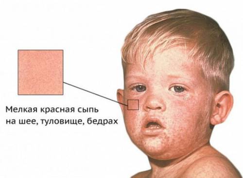 Сыпь при ветрянке