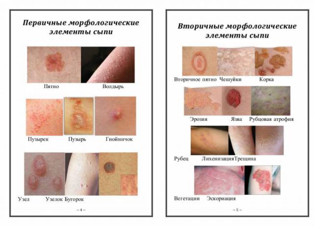 Элементы сыпи