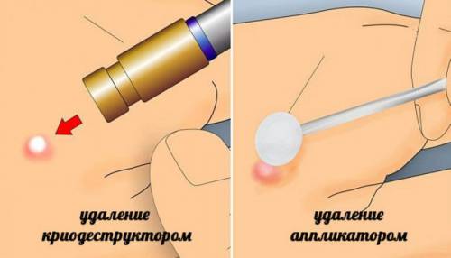 Разные способы криодеструкции