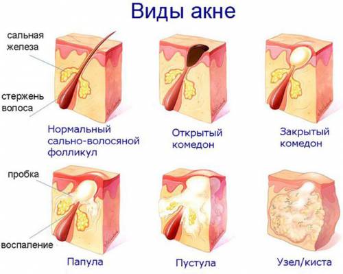 Виды акне