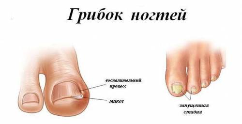 Грибок на ногах