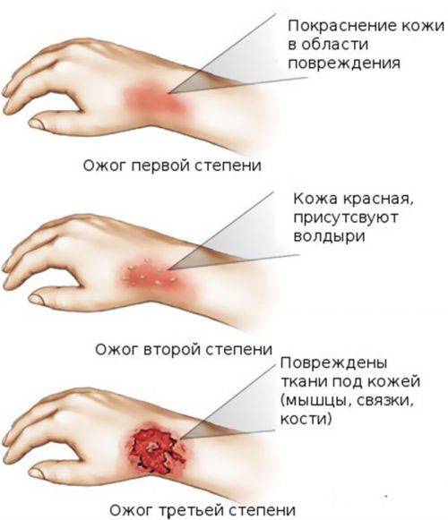 Степени тяжести ожогов