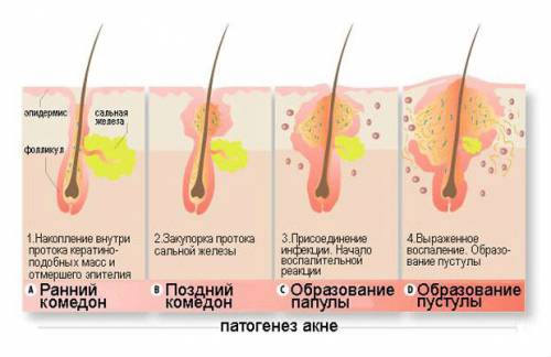 Образование акне