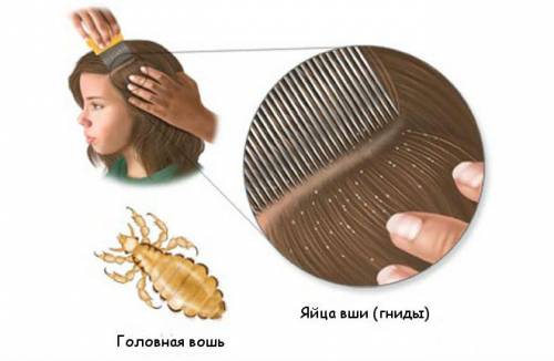 Педикулез